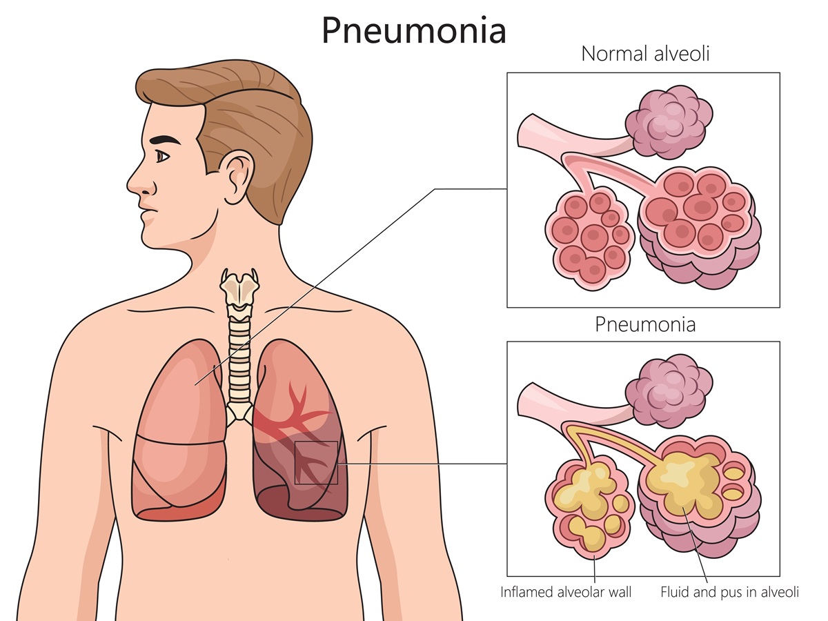 Pneumónia a zápal pľúcneho tkaniva